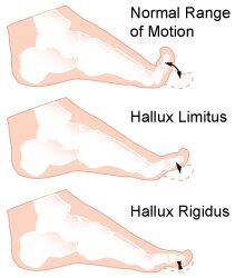 Hallux Rigidus and Hallux Limitus