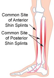 Shin Splints