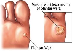 Plantar_Wart