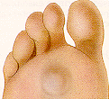 Tailor’s Bunion