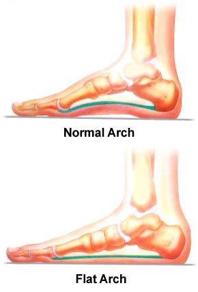 FLAT ARCH