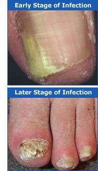 Nail Fungus