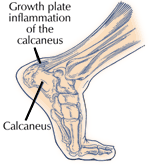 Sever’s Disease